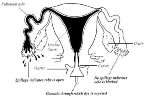 hysterosalpingogram_diagram